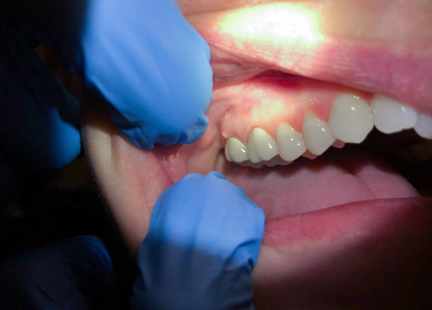 Best Emergency Dental Filling Replacement  in Chestnut Ridge, NY